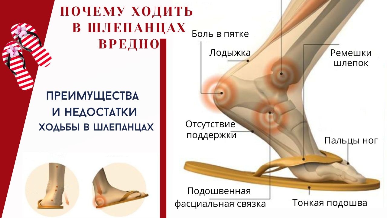 ходить в шлепанцах вредно